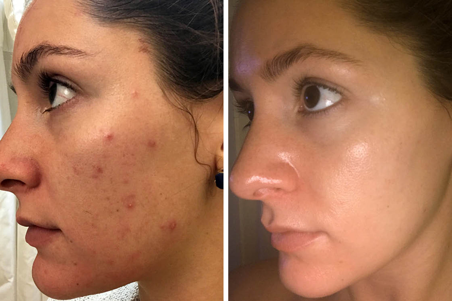 Bubblegum™ ClearSkin Dots